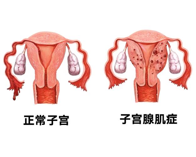 试管腺肌症