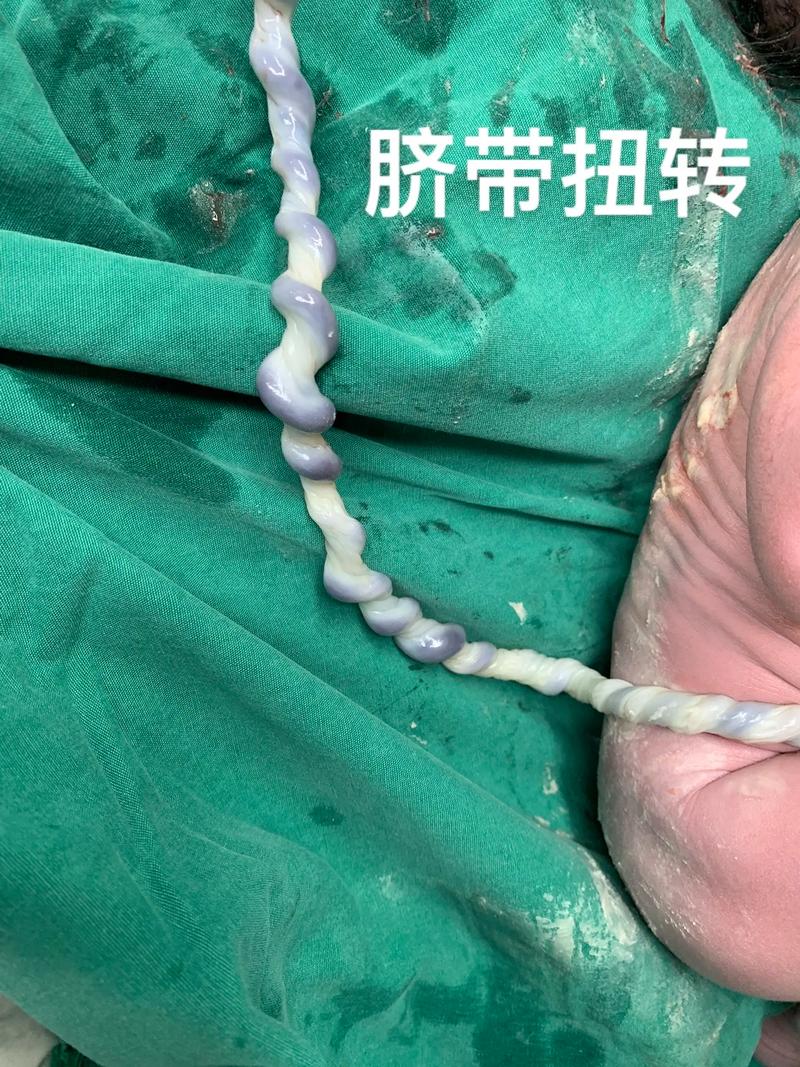 脐带扭转