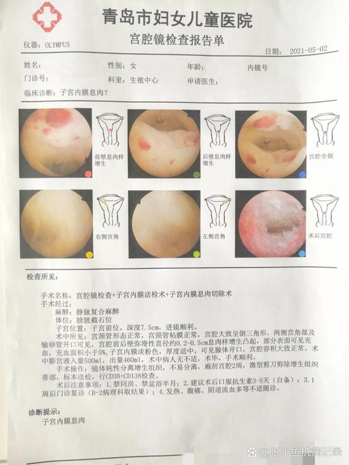  子宫内膜炎