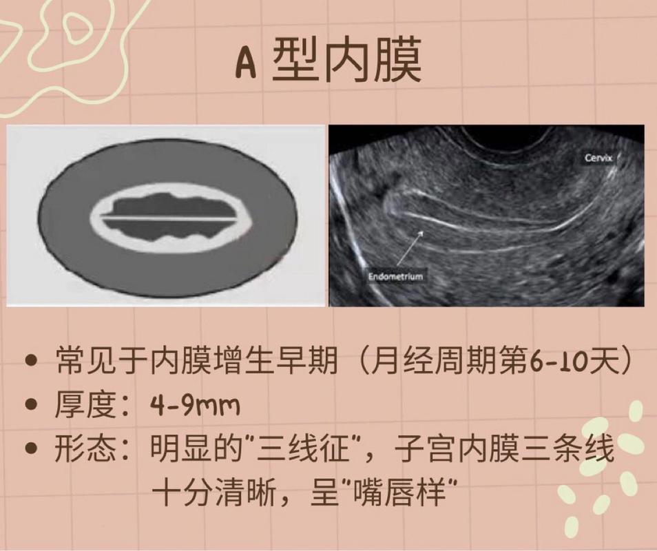 试管内膜C型
