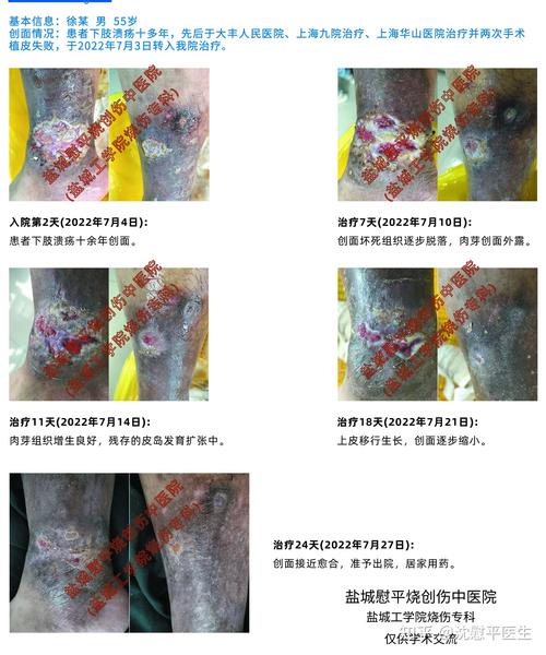 失败后治疗