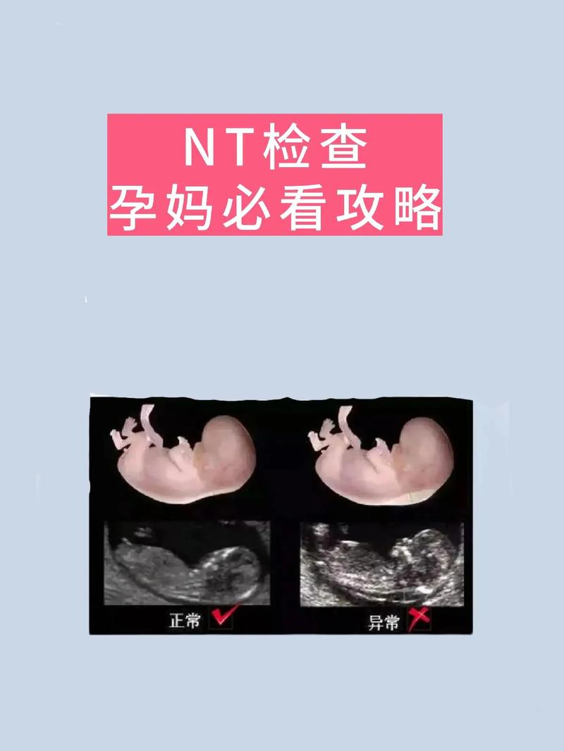 NT检查