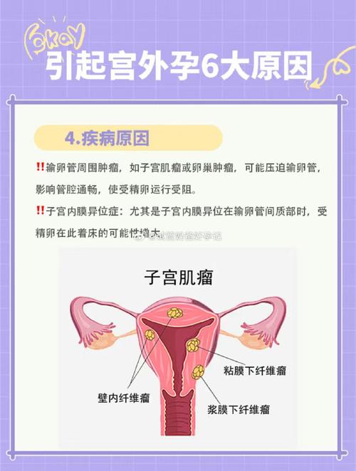 宫外孕影响因素