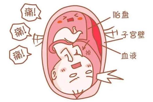  宫内窘迫
