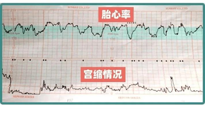  胎心率异常