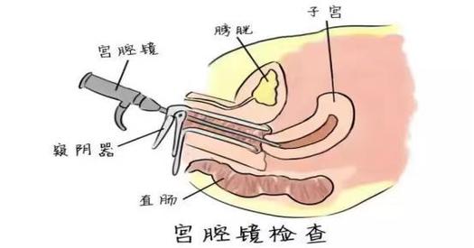 取囊胚技术