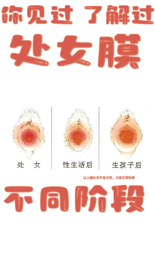 处女膜误区