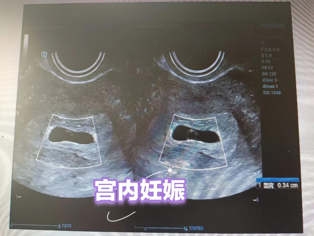 两枚胚胎移植