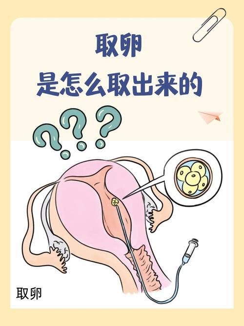  取卵泡