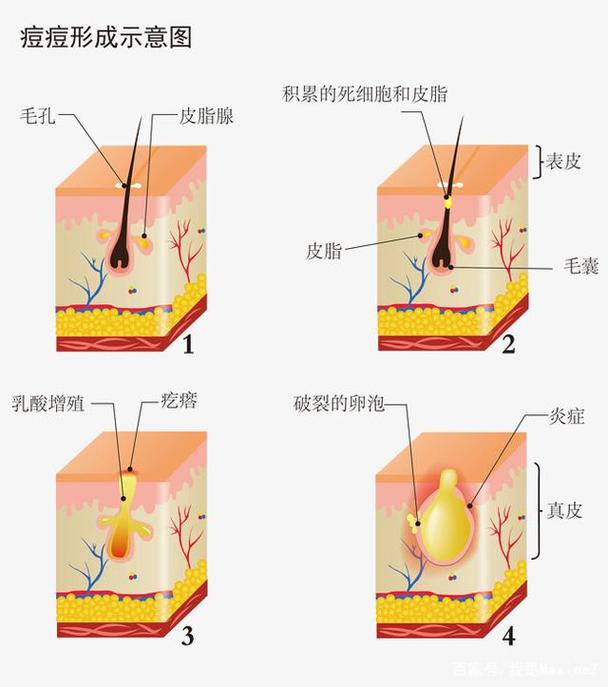成因