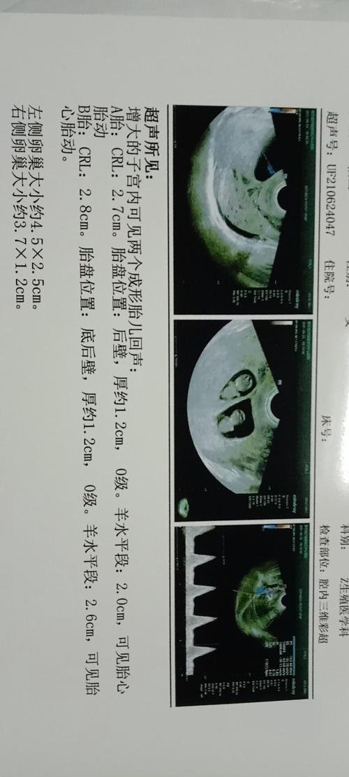 移植48天