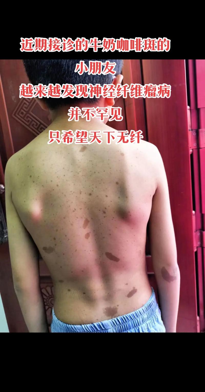 神经纤维瘤