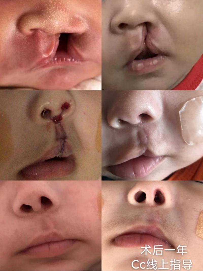 唇腭裂手术