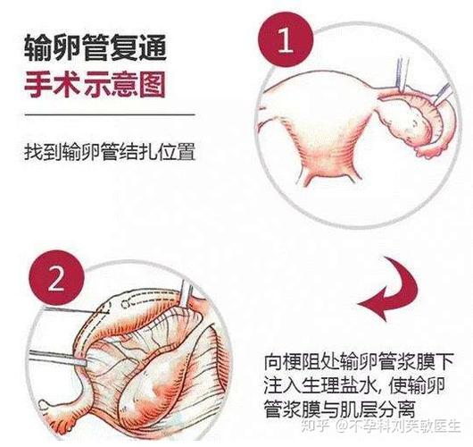 输卵管修复