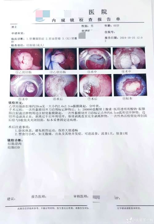 结肠癌