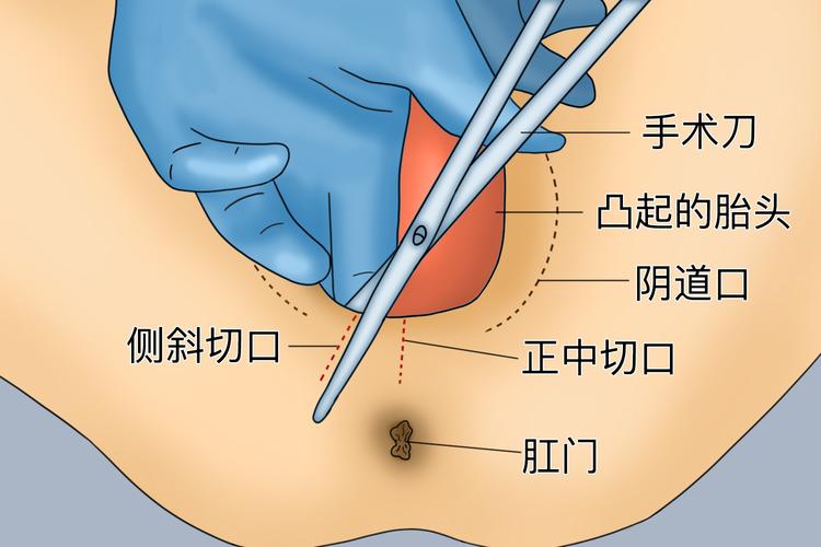 产妇侧切