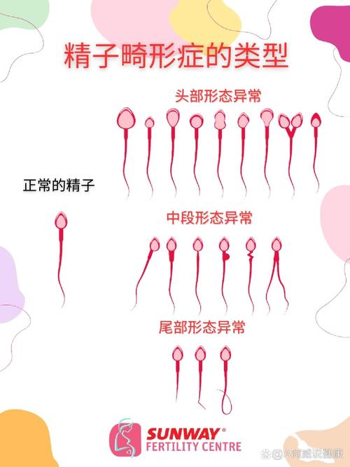圆头精子症