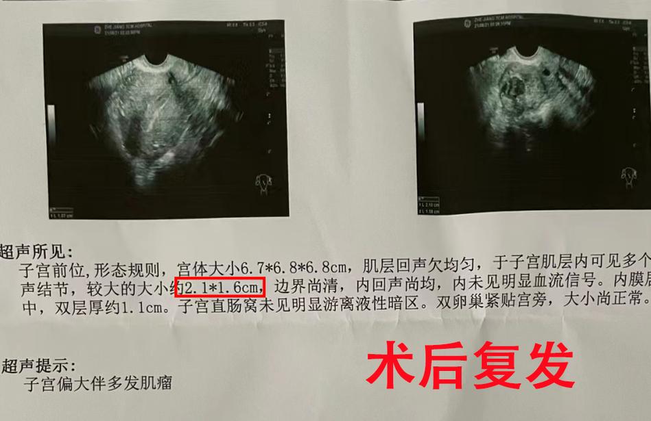 术后复发