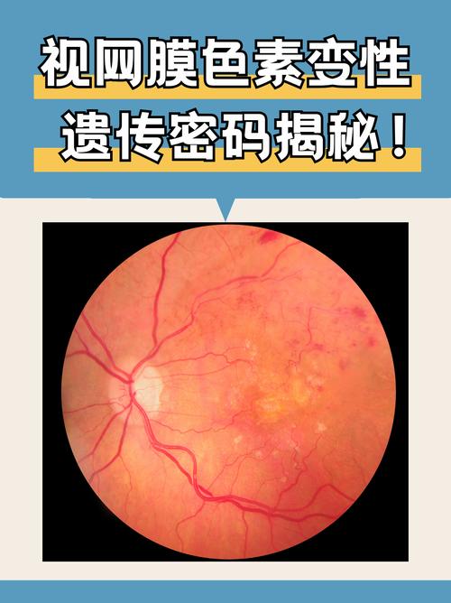 遗传性眼病