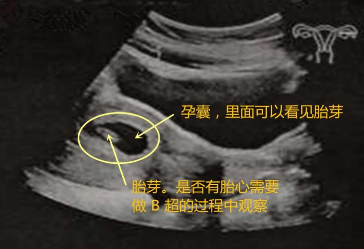 7周B超检查