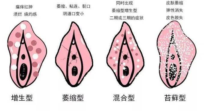 外阴白斑
