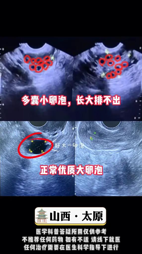无法取出卵泡