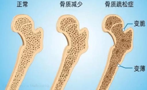  骨密度