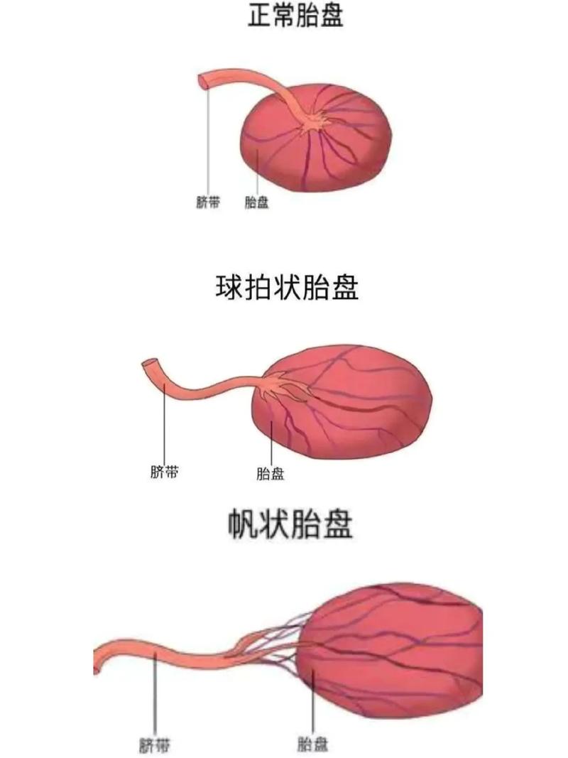 胎盘问题