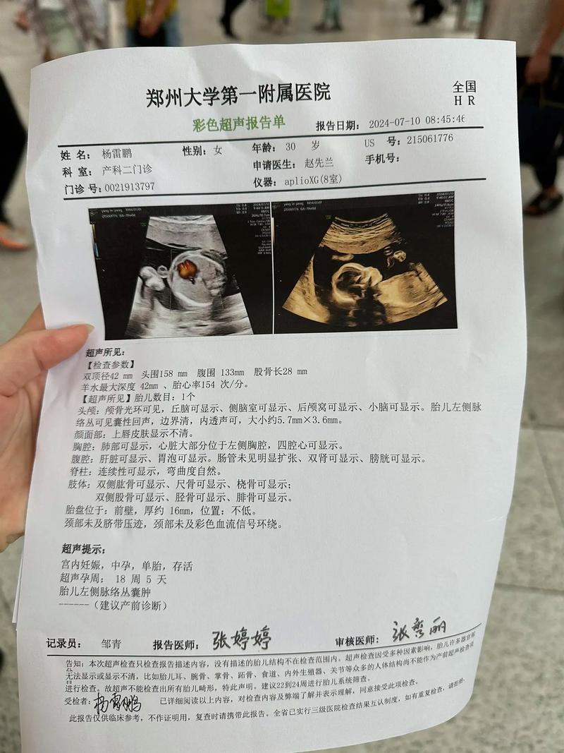 脉络丛囊肿