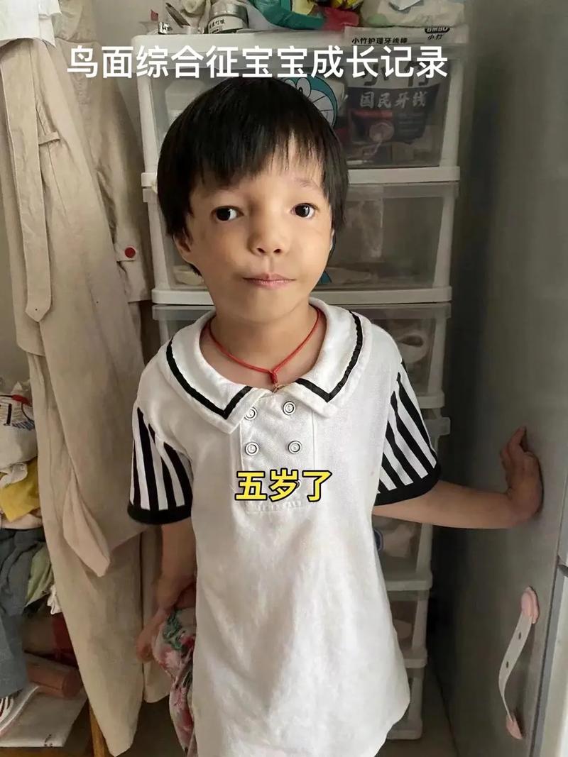 鸟面综合征