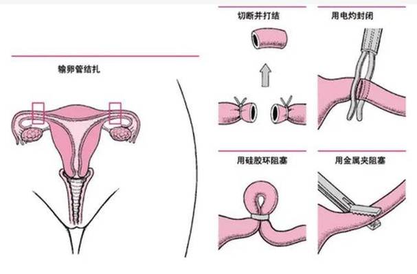结扎复通