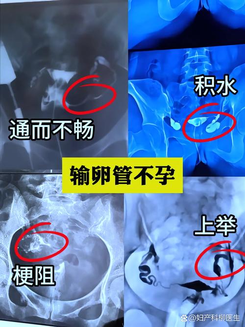  输卵管造影