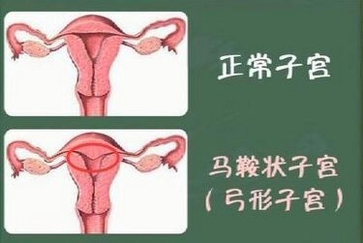 鞍型子宫