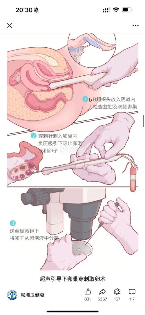 单取卵