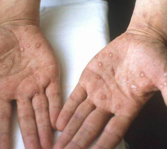 HIV患者