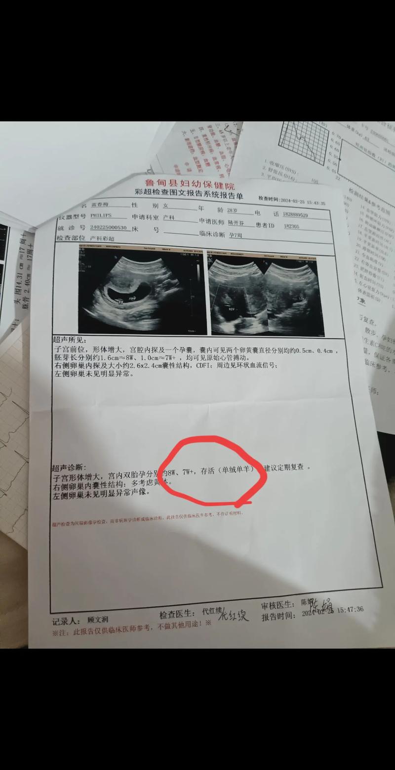 双胞胎检测