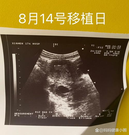 五天胚胎移植