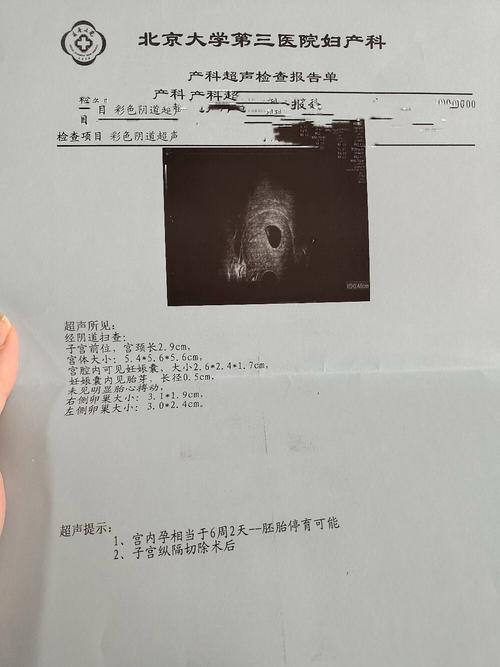 八周胎心停