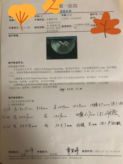 促排卵泡报告
