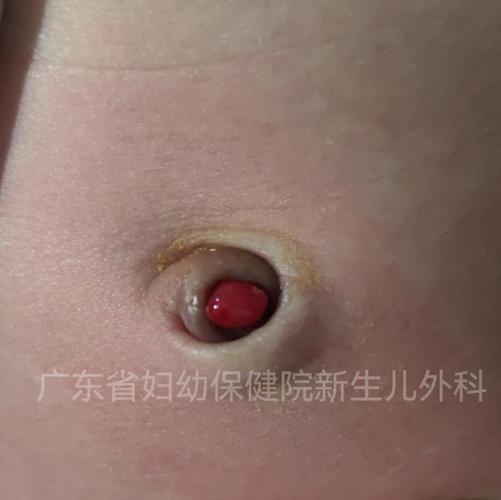 脐带异常