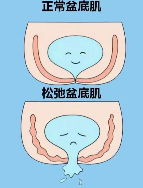 盆底肌肉松弛