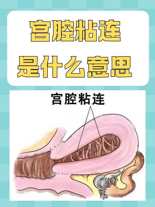 宫腔内膜粘连