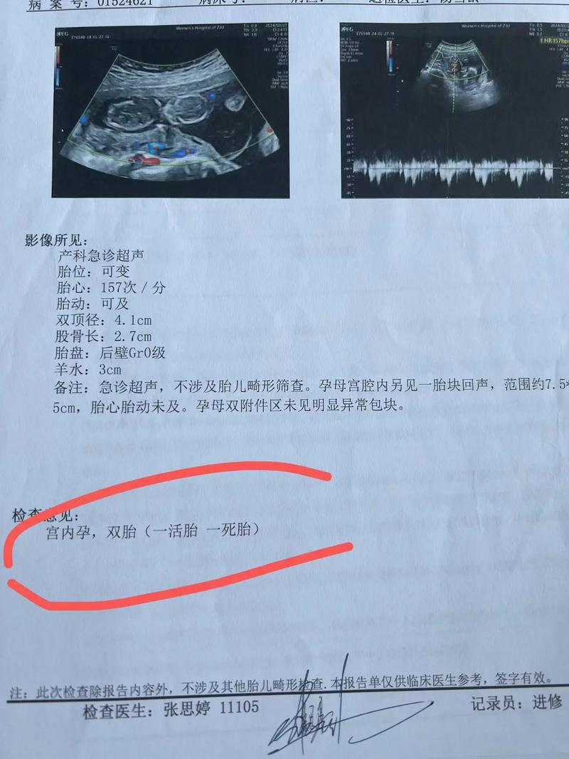 没胎心几率