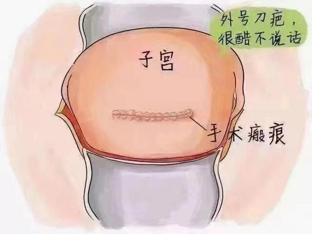 宫颈疤痕