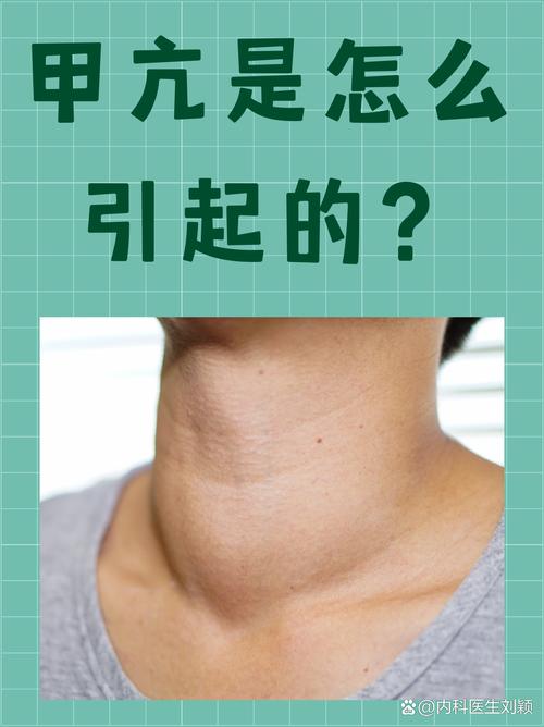  甲状腺功能亢进