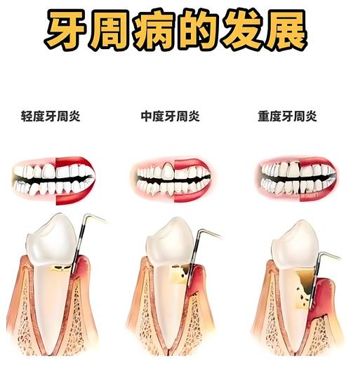  牙周病