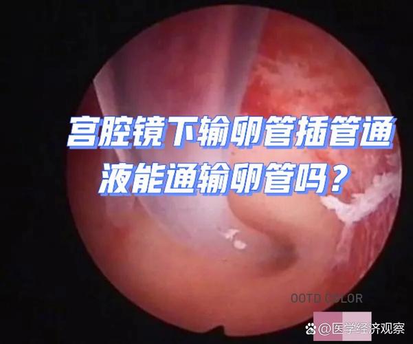  输卵管通液术