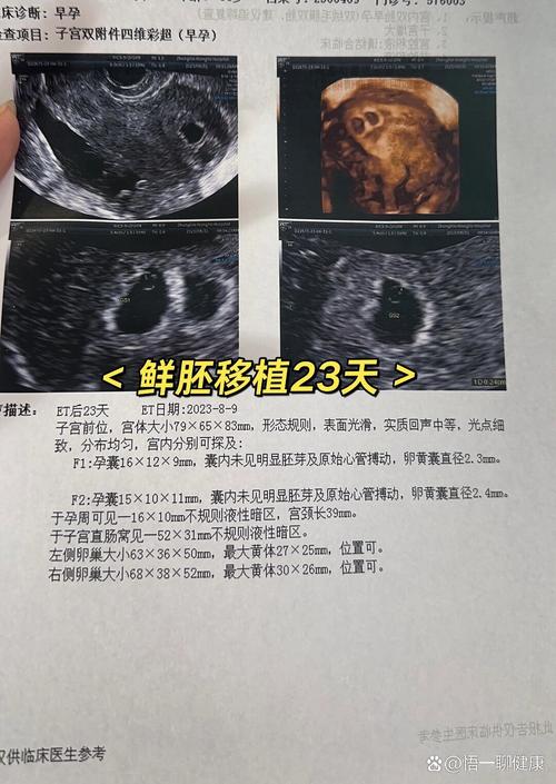  双胎移植