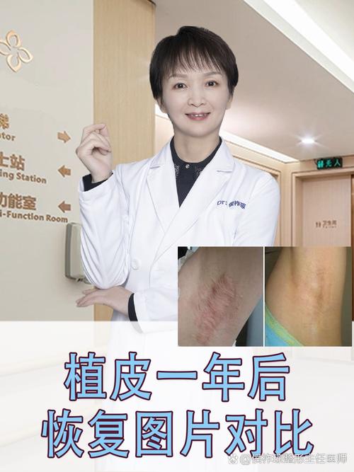 一年后移植