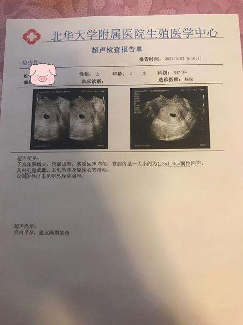 移植21天